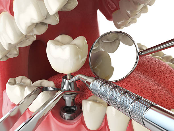 Best Emergency Root Canal Treatment in Kent City, MI